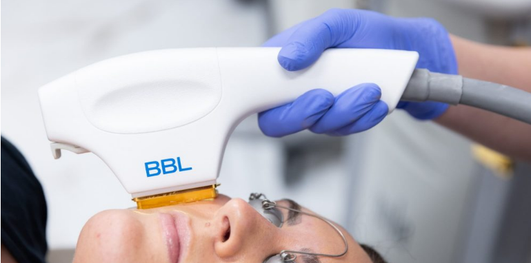 Can I Use Hydroquinone After Broad Band Light Treatment?